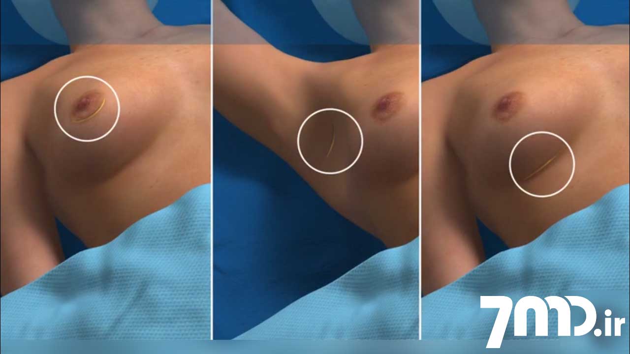 انیمیشن جراحی پلاستیک